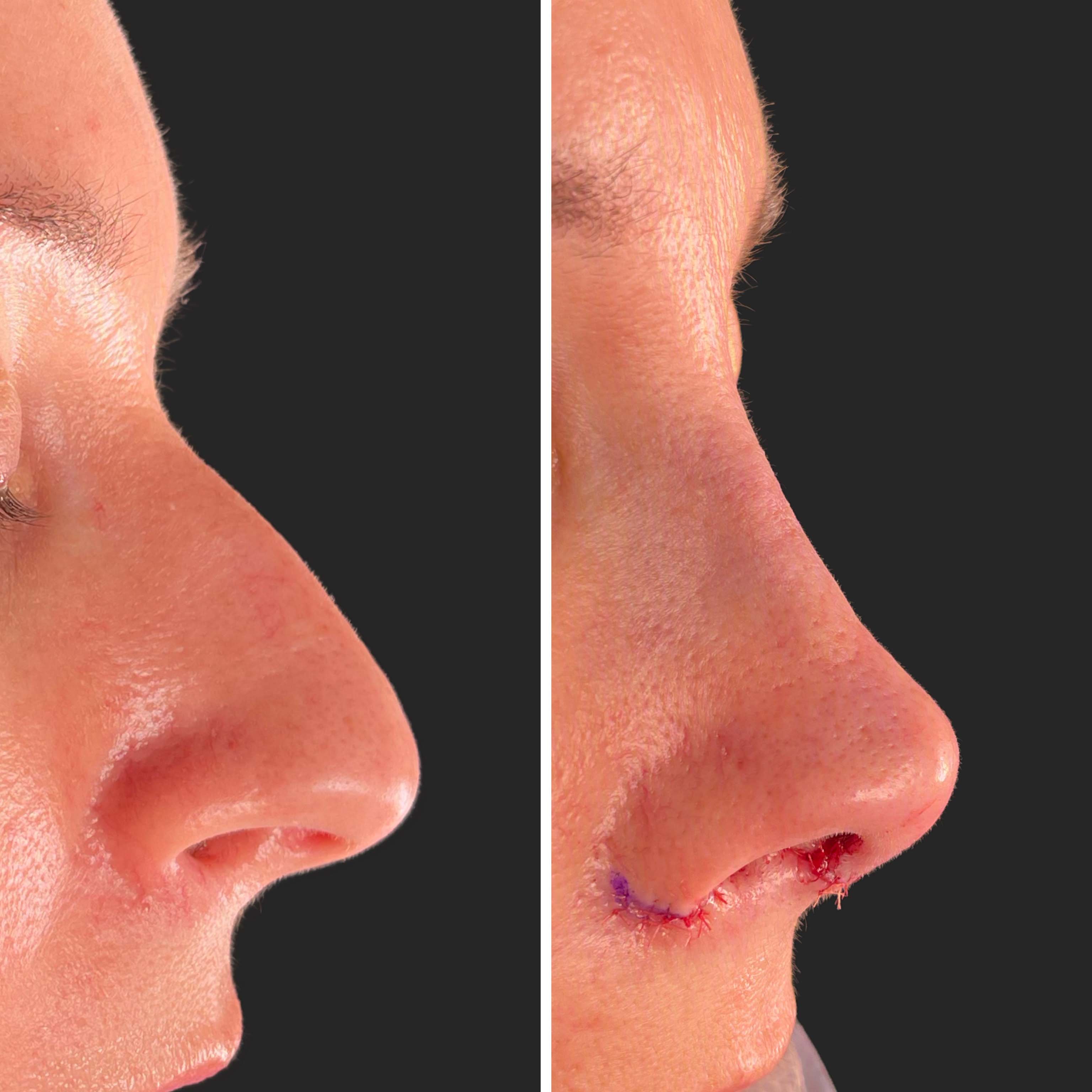 Patient — Before and After Rhinoplasty