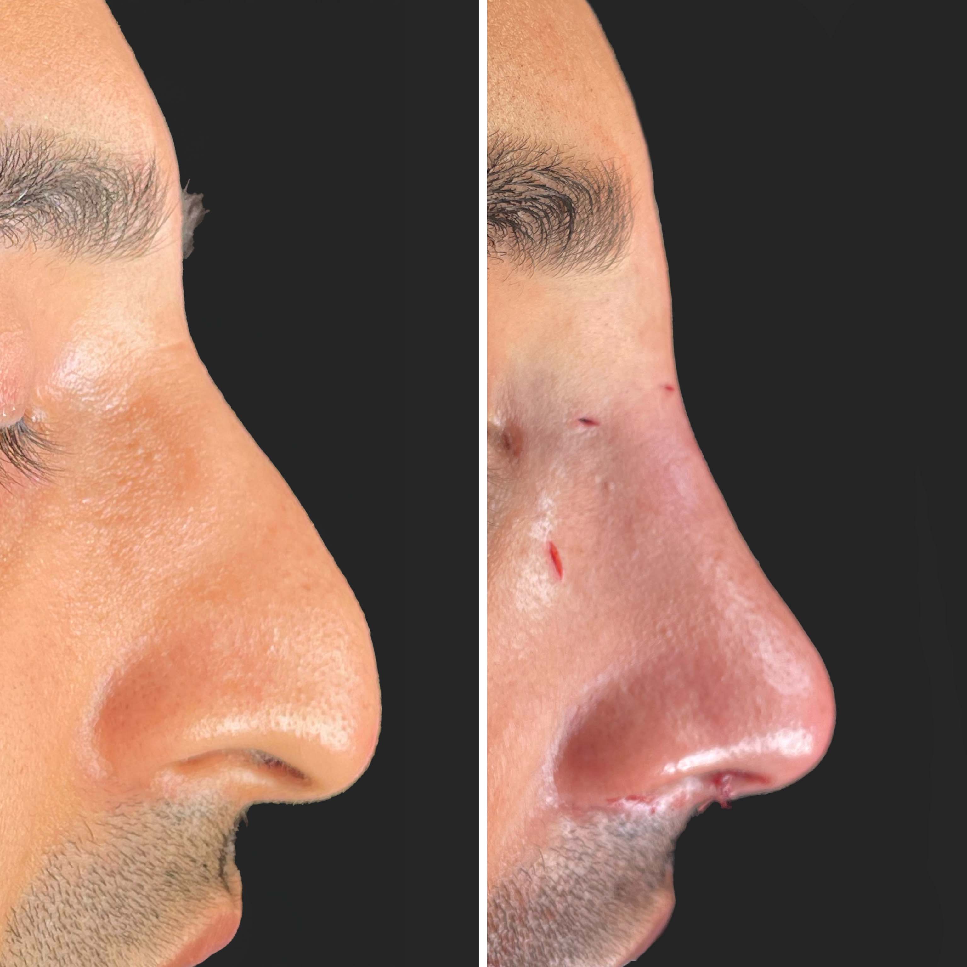 Gurwinder — Before and After Rhinoplasty