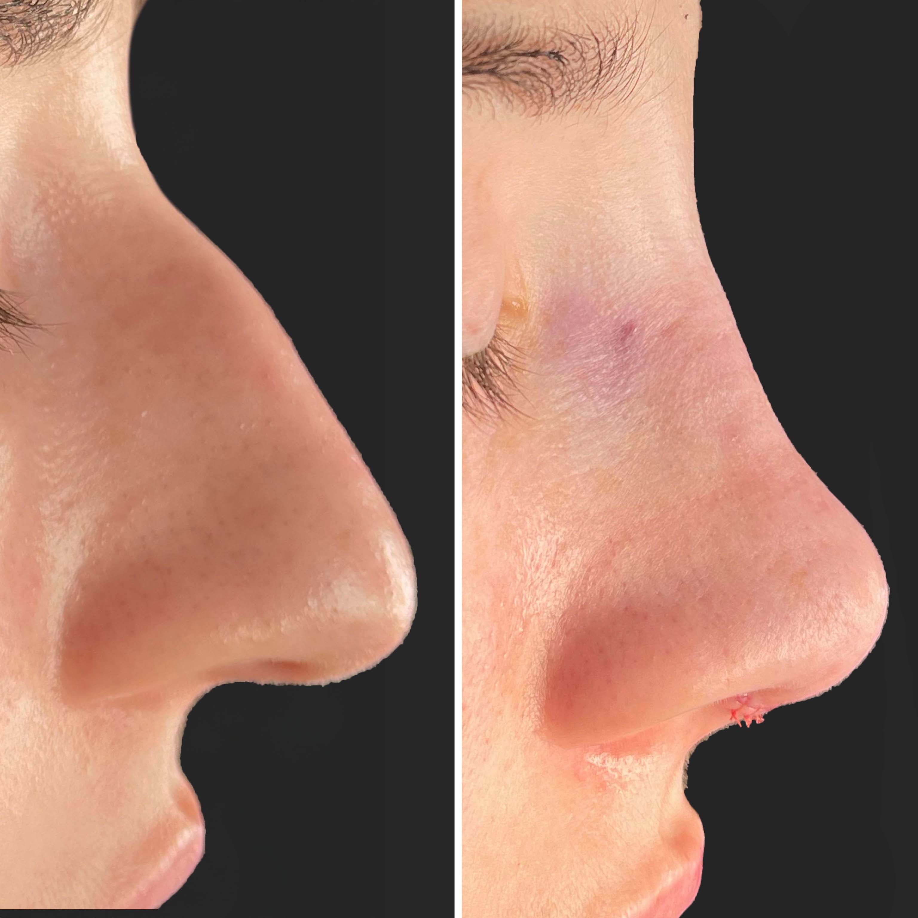 Janie — Before and After Rhinoplasty