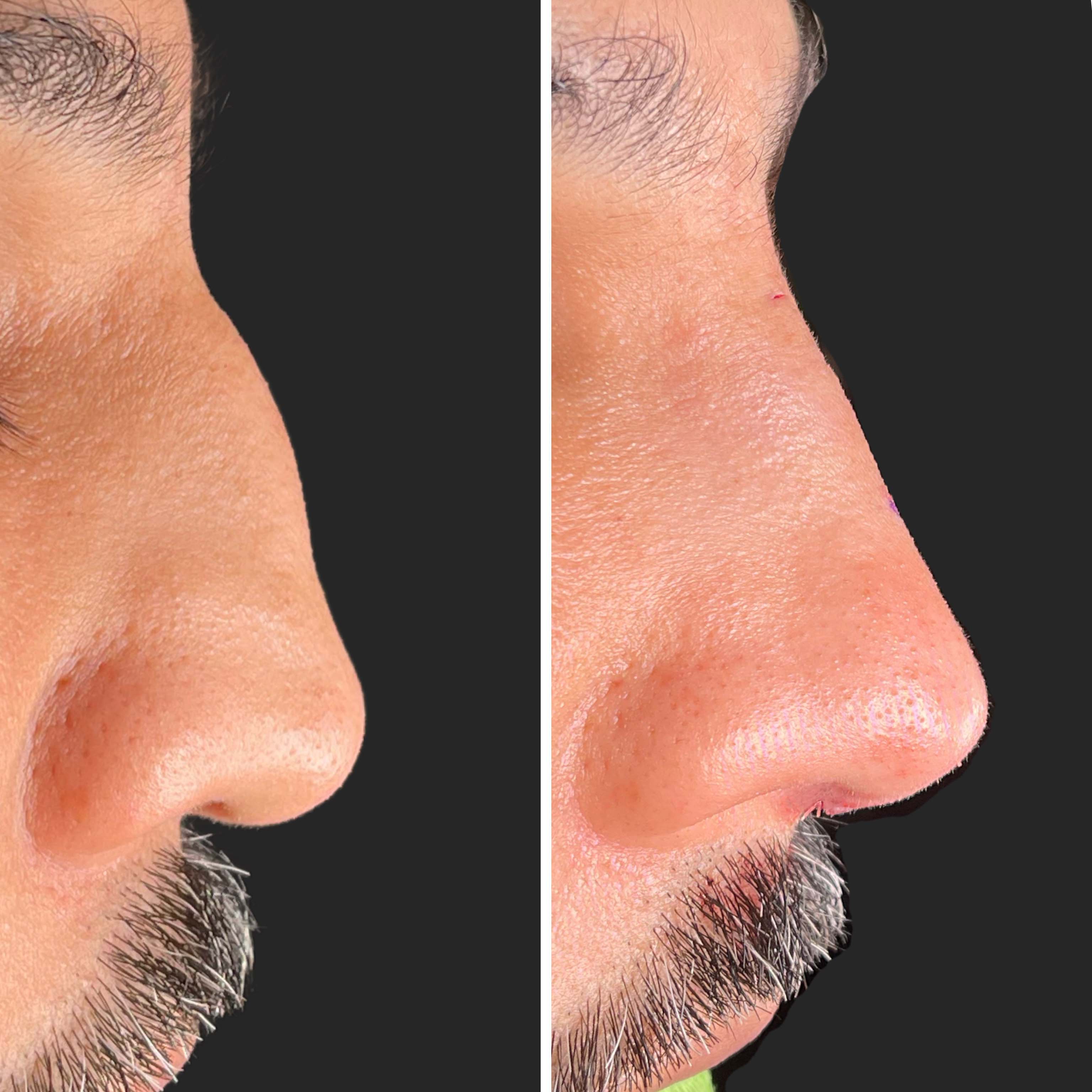 Kamran — Before and After Rhinoplasty